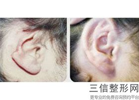 耳软骨隆鼻多久可以侧睡(新耳软骨隆鼻尖需要注意什么 汪垟)