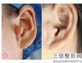 耳软骨隆鼻多久可以侧着睡(新硅胶+耳软骨隆鼻第四天侧面睡觉会影响效果吗)
