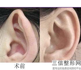 耳软骨隆鼻多少钱啊(新自体软骨隆鼻的价格大概需要花多少钱)