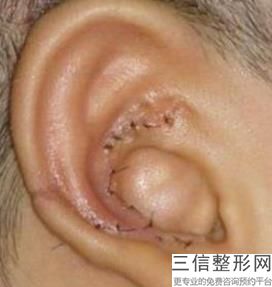 耳软骨隆鼻耳软骨隆鼻(新隆鼻大概花多少钱)