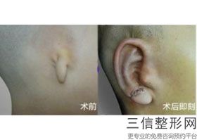 耳软骨隆鼻根(新特需医疗服务项目包括)