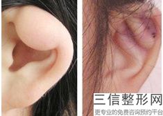 耳软骨隆鼻过程(新一起来了解二次隆鼻的重建手术介绍)