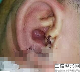 耳软骨隆鼻和肋骨隆鼻哪个效果好(新冯雁平自体耳软骨隆鼻多少钱)