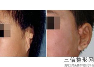 耳软骨隆鼻花多少钱(新耳软骨隆鼻梁会不会不高啊)