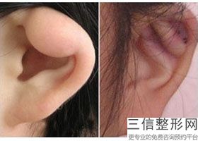 耳软骨隆鼻会不会有什么后遗症(新自体软骨隆鼻的危害有哪些)