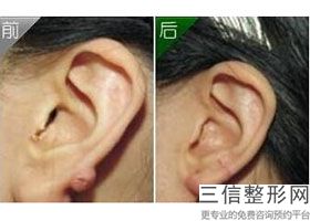 耳软骨隆鼻会穿孔吗(新自体软骨隆鼻有哪些优缺点)