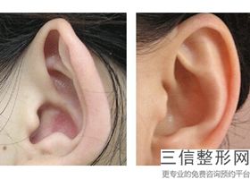 耳软骨隆鼻会歪吗(新取耳软骨隆鼻后耳朵有什么影响吗)