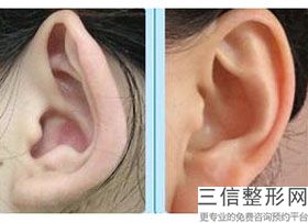 耳软骨隆鼻会吸收多少(新耳软骨隆鼻有没有好处)