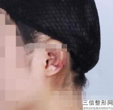 耳软骨隆鼻会有什么后遗症(新鼻整形垫完耳软骨鼻头会变大吗)