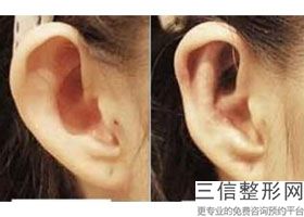 耳软骨隆鼻价格大概(新赵延峰自体软骨隆鼻价格是多少)