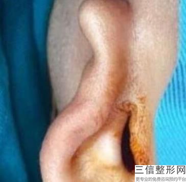 耳软骨隆鼻价格多少钱(新韩国做隆鼻手术多少钱)
