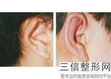 耳软骨隆鼻价格(新假体隆鼻恢复时间要多长)