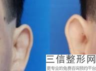 耳软骨隆鼻能改善鼻头吗(新自体软骨隆鼻会不会移位)