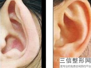 耳软骨隆鼻手术一般价格是多少(新隆鼻大概花多少钱)