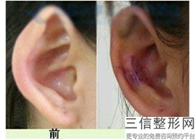 耳软骨隆鼻一般价格(新耳软骨隆鼻需要多钱)