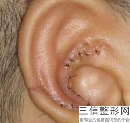 耳软骨隆鼻一般要多少钱(新耳软骨隆鼻伤害耳朵吗 刘彦军)