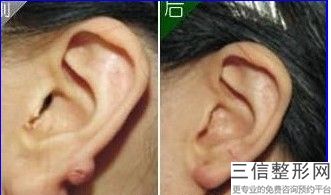 耳软骨怎么隆鼻(新用耳软骨隆鼻过几年后还要取出来换一个吗)