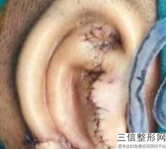 耳软骨整形隆鼻(新耳软骨隆鼻手术效果怎么样)