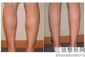 法国es隆胸多少钱(新法国es假体 好还是女人花假体丰胸好隆胸多少钱)