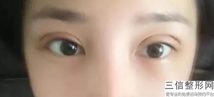 方形脸适合什么双眼皮(新女生常见的双眼皮类型有哪些)