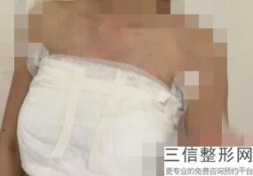 丰乳手术大概多少钱(新女人隆胸需要多少钱)