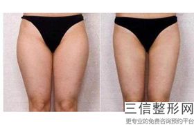 丰乳手术怎么做(新请教如何快速丰胸啊愁死了 )