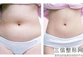 丰胸安全可靠(新健康安全的丰胸 方式 现在有不)