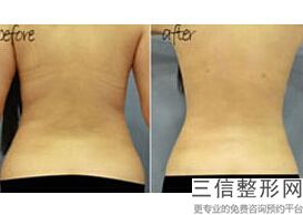 丰胸对身体危害有哪些(新6s棉花胸有什么危害)