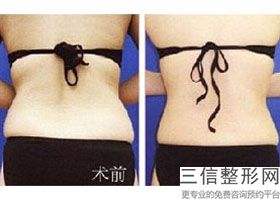 丰胸对身体有坏处吗(新做乳房悬吊术能矫正乳房下垂吗假体隆胸效果怎么样啊_千问健康)