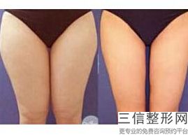 丰胸对身体有什么危害(新脂肪填充丰胸有什么危害吗)
