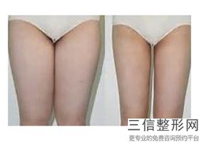 丰胸会不会有后遗症吗(新中科美陈美运胸整形丰胸怎么样)