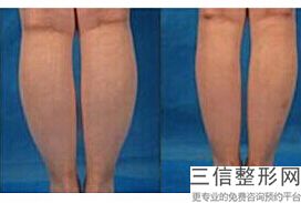 丰胸假体都有哪些牌子(新南京华美假体丰胸效果好不好 有没有失败案例)