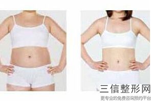 丰胸假体价格多少钱(新想问一下有没有谁 做过假体隆胸手术的啊)
