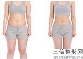 丰胸假体价格贵不贵(新花样年华假体丰胸)