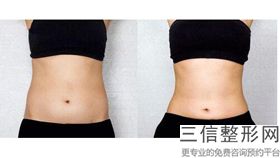 丰胸假体隆胸手术(新男士假体隆胸的人多吗)
