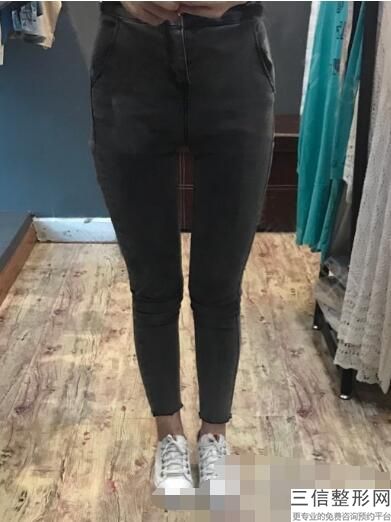 丰胸假体术手术(新乳房整形手术是什么)