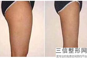 丰胸假体植入多少钱(新买不用检查认证的丰胸产品要去哪里买)