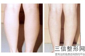 丰胸隆胸要花多少钱(新乳房再造术多少钱新农合能报销吗)