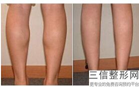 丰胸哪家医院(新上海解放军455医院做隆胸手术怎么样)