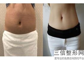 丰胸哪里效果好(新麦格假体隆胸的效果好不好_千问健康)
