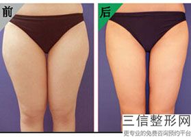 丰胸哪种比较安全(新什么牌子的丰胸乳好.)
