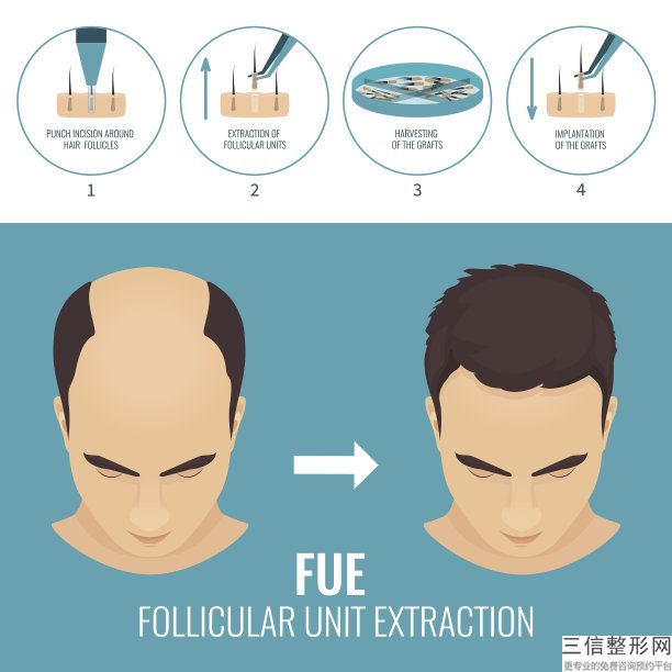 fue和aht植发技术区别(植发fue和aht技术差别大吗)