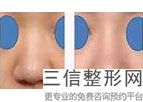 鼻综合隆鼻的风险大吗(鼻综合隆鼻好吗)