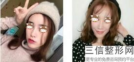 鼻综合手术千万别做(鼻综合手术有没有风险)