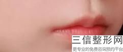 玻尿酸丰唇多久见效(玻尿酸丰唇多久见效果)