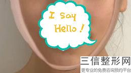 玻尿酸丰唇多久能自然吸收(玻尿酸丰唇多久能自然吸收掉)