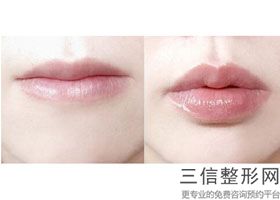 玻尿酸丰唇好几年没吸收完(玻尿酸丰唇好几年没吸收完怎么办)