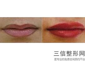 玻尿酸丰唇能维持多长时间(玻尿酸丰唇能维持多长时间呢)