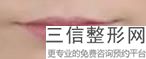 玻尿酸丰唇痛感如何(玻尿酸丰唇特别疼)