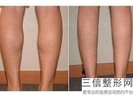 玻尿酸丰胸能管多久(玻尿酸丰胸能管多久呢)